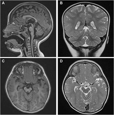 Case report: A new de novo 6q21q22.1 interstitial deletion case in a girl with cerebellar vermis hypoplasia and developmental delay and literature review